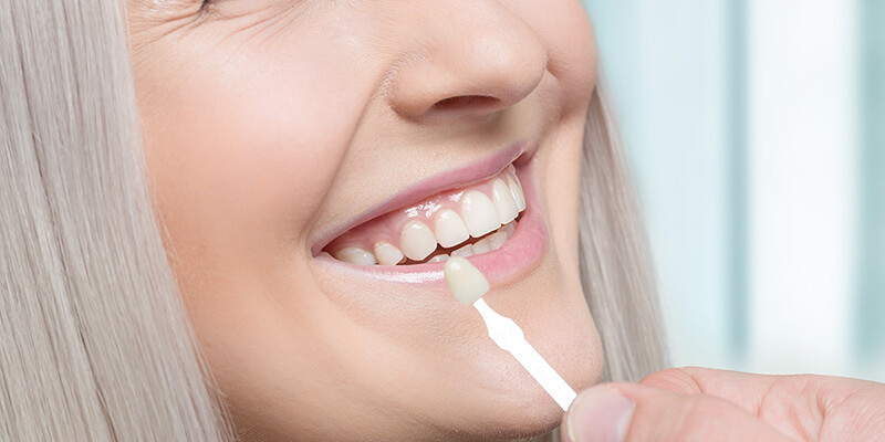 Eine Verblendung auf der Frontseite der Zähne lässt die Optik korrigieren.