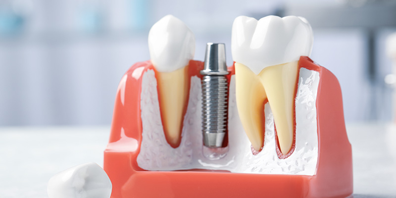 Zahnimplantate zu ungarischen Preisen